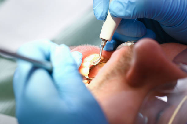 Best Emergency Wisdom Tooth Extraction in North Eagle Butte, SD